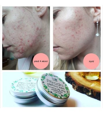 Biorythme Přírodní pleťový krém Anti Pupínek 30ml praha obchod